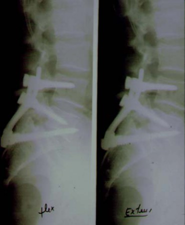 reducción de espondilolistesis con tornillos transacro-L5 (técnica de fusión in situ según Abdu)